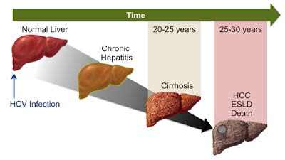 Liver Cancer Stages