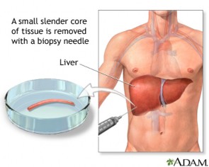 A liver biopsy is not a routine procedure, but is performed when it is necessary to determine the presence of liver disease and to look for malignancy, cysts, parasites, or other pathology.  The actual procedure is only slightly uncomfortable.  Most of the discomfort arises from being required to lie still for several hours afterwards to prevent bleeding from the biopsy site.